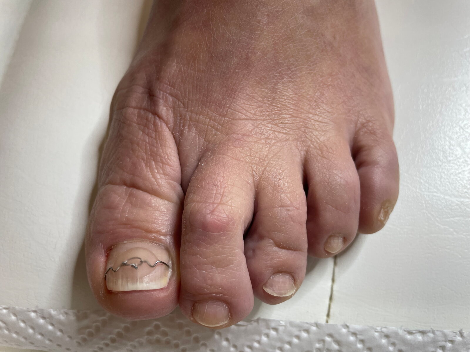 3 TO Spange von der Fußpflege & Nagelstudio Beatrice Varkus