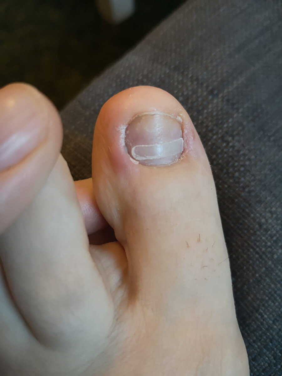 Klebespange von der Fußpflege & Nagelstudio Beatrice Varkus