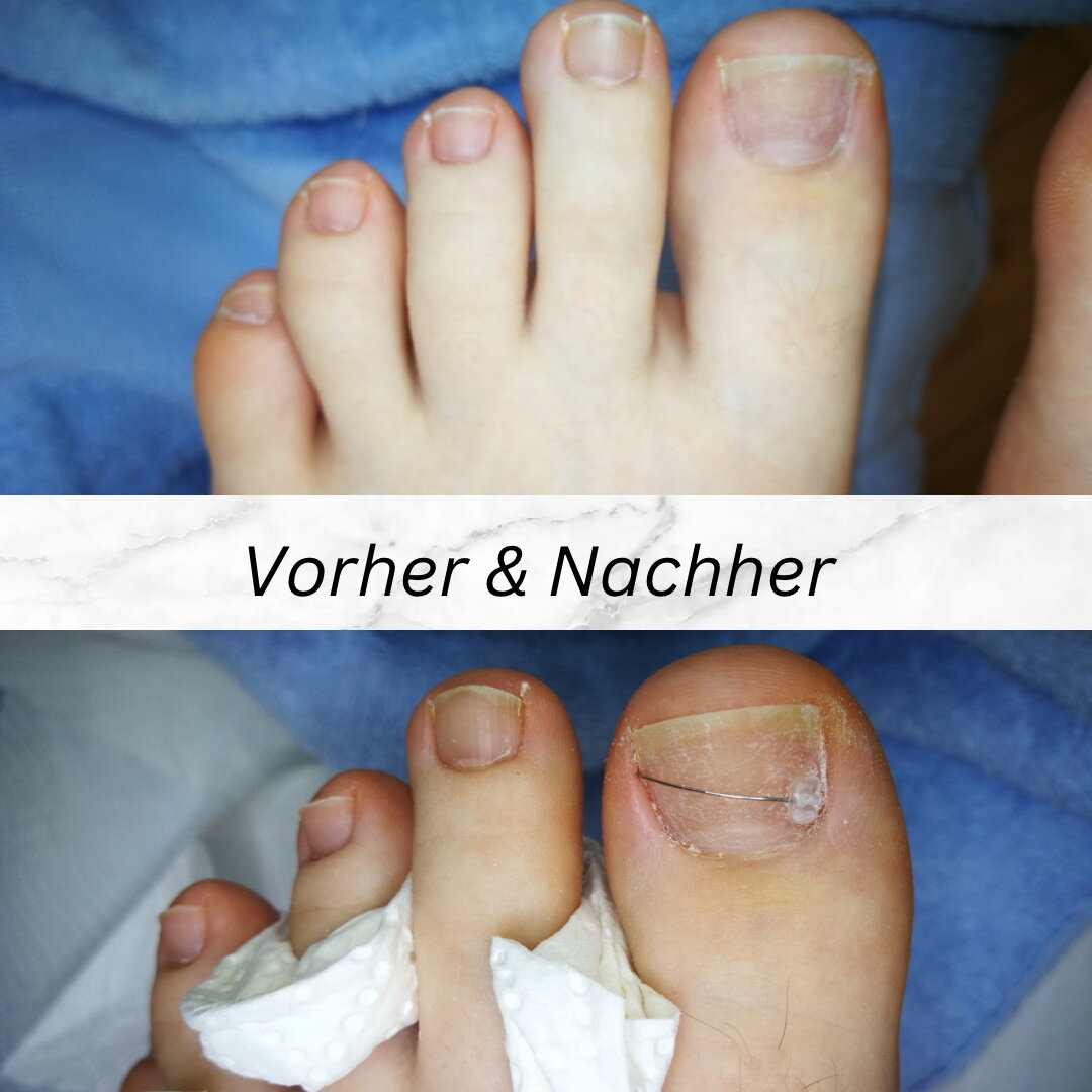 COMBIped Spange vorher und nachher