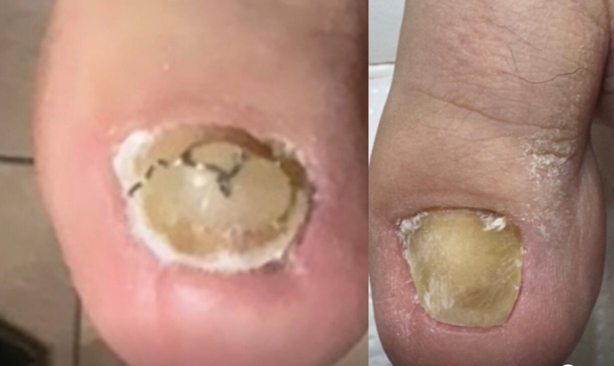 Nagelspange Vorher Nachher