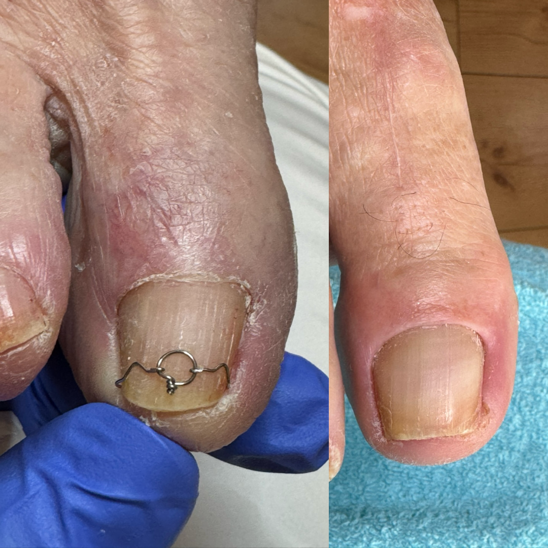 Nagelspange Vorher Nachher