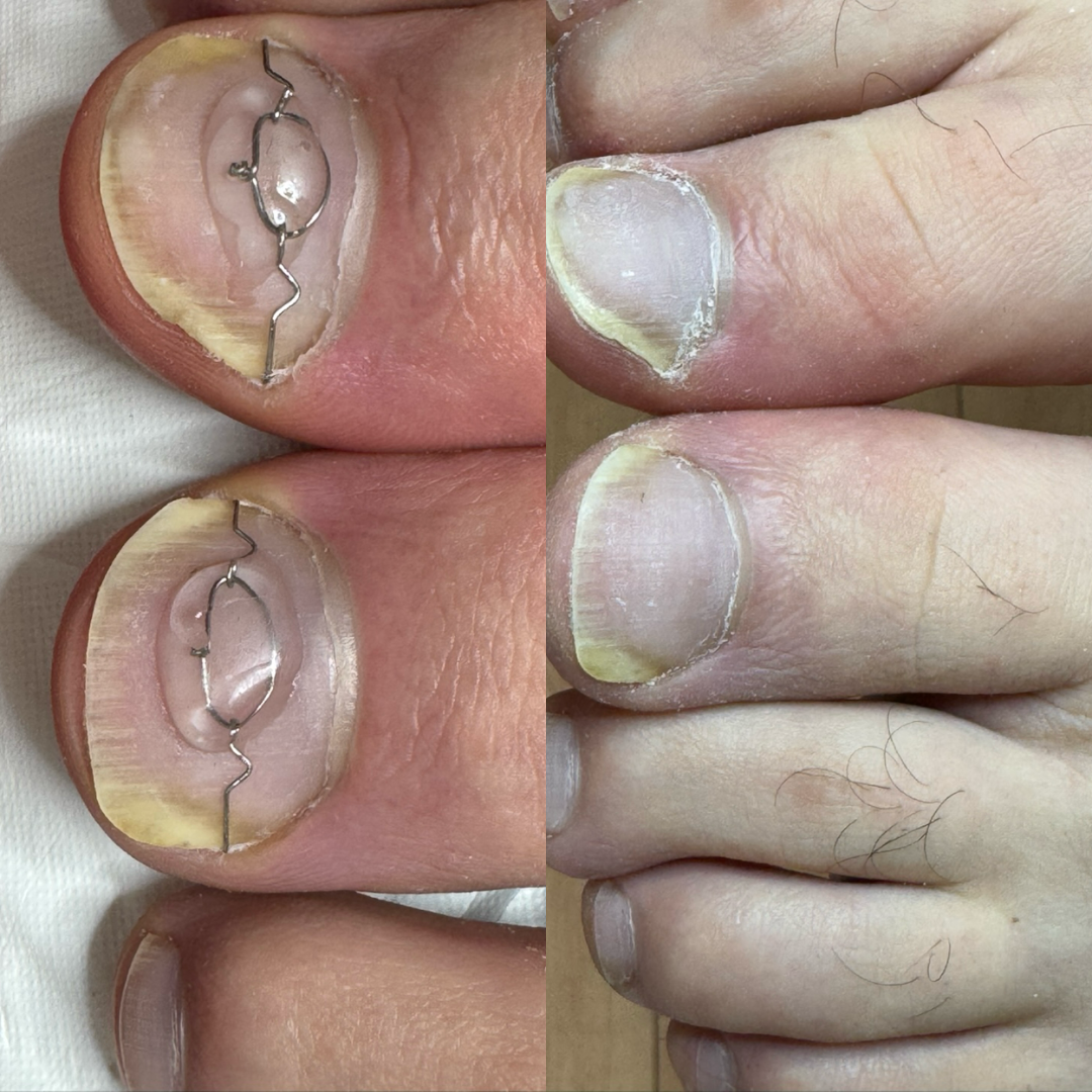 Nagelspange Vorher Nachher